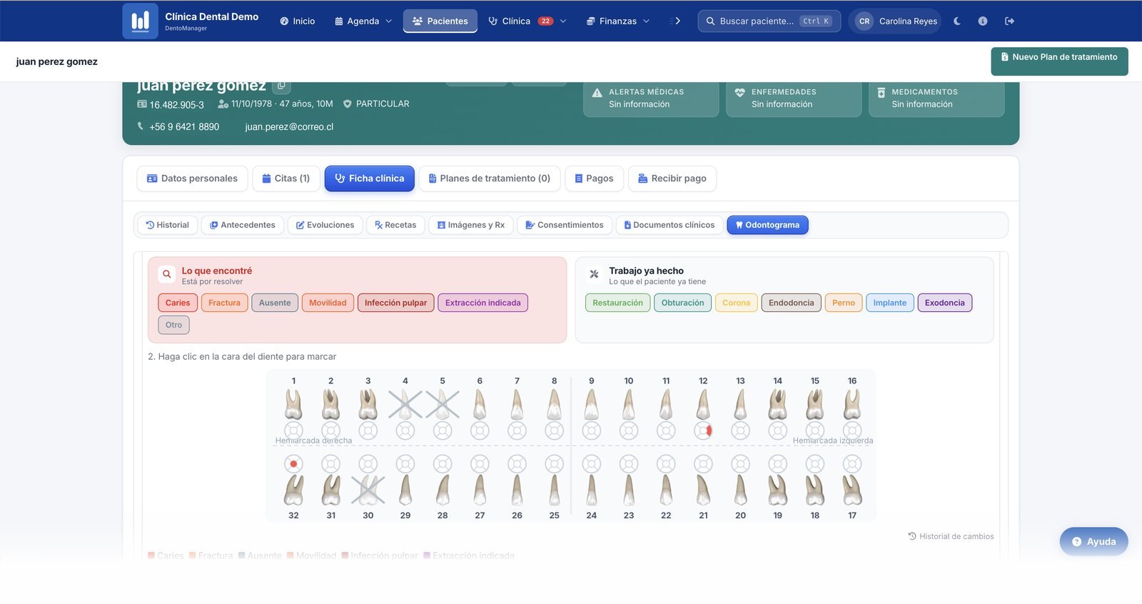 Odontograma de un paciente en DentoManager: los dientes con sus hallazgos marcados por pieza y por cara, separados entre lo que está por resolver y el trabajo ya hecho.